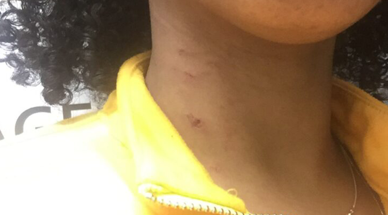 Sara Micheal says it took over two weeks to give a statement to RCMP following a racist assault that left her with neck scars.